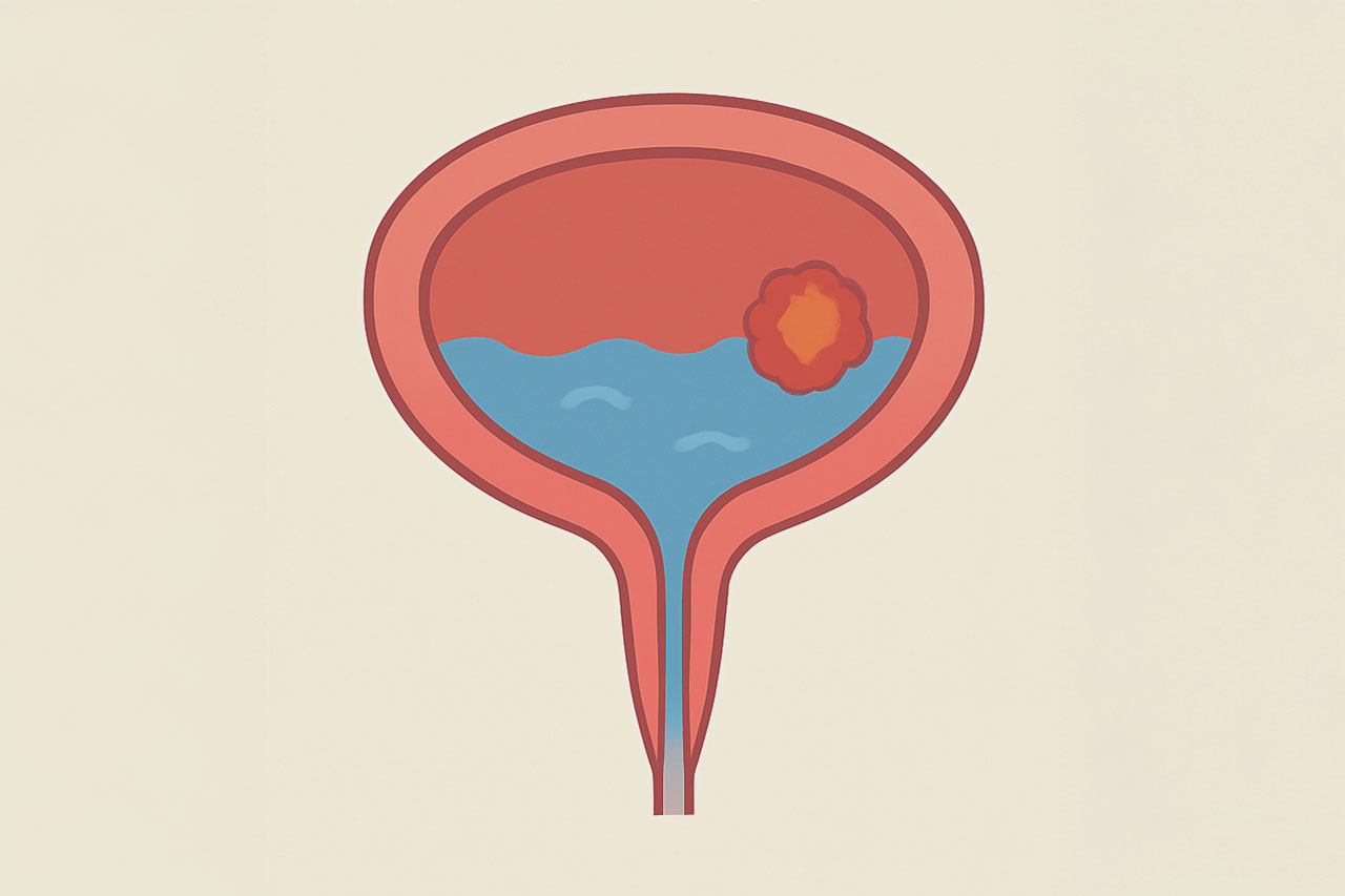 conditions-bladder-cancer